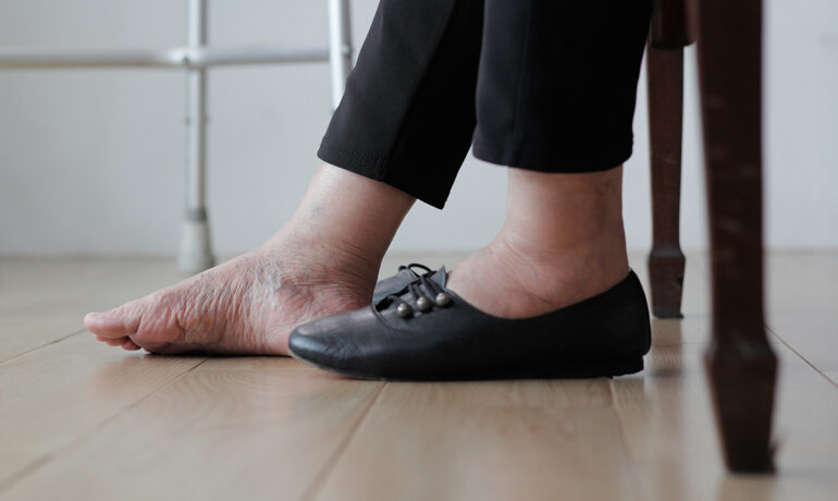 Отечность ног у пожилых