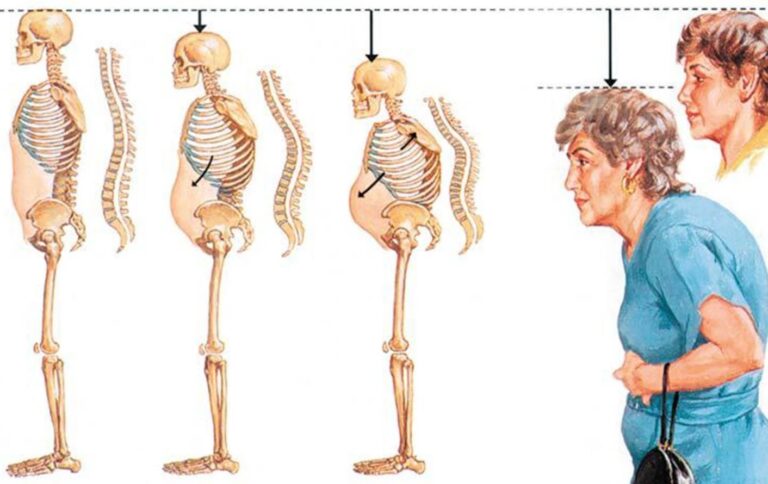 Симптомы остеопороза