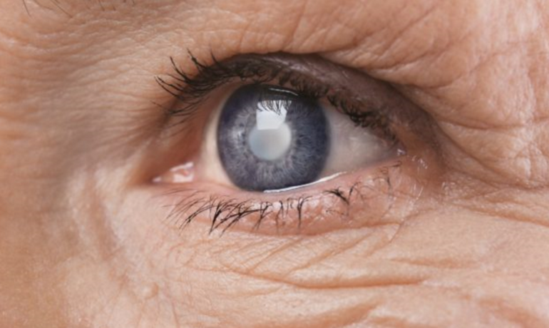 катаракта в пожилом возрасте